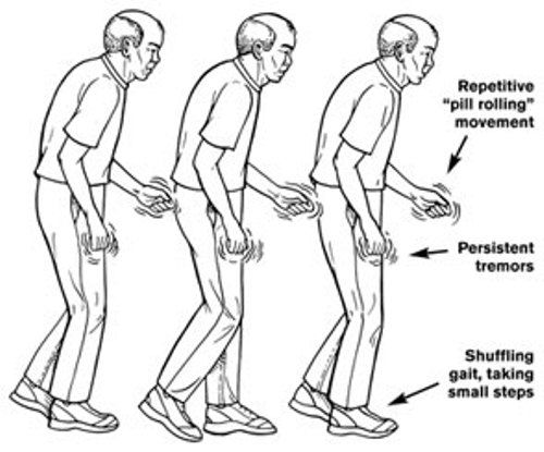 LBDtools.com | Parkinsons Disease